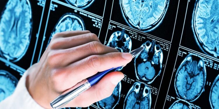 Yeni Bileşik Alzheimer Tedavisinde Umut